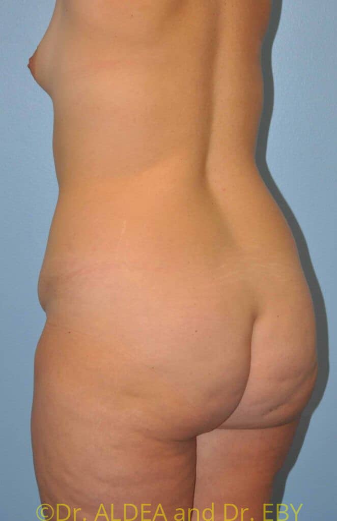 Before Image: Back Scoop Liposuction #765 - left-back-oblique
