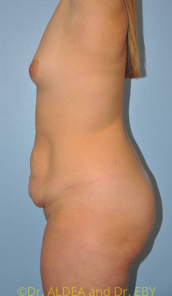 Before Image: Back Scoop Liposuction #765 - left-side