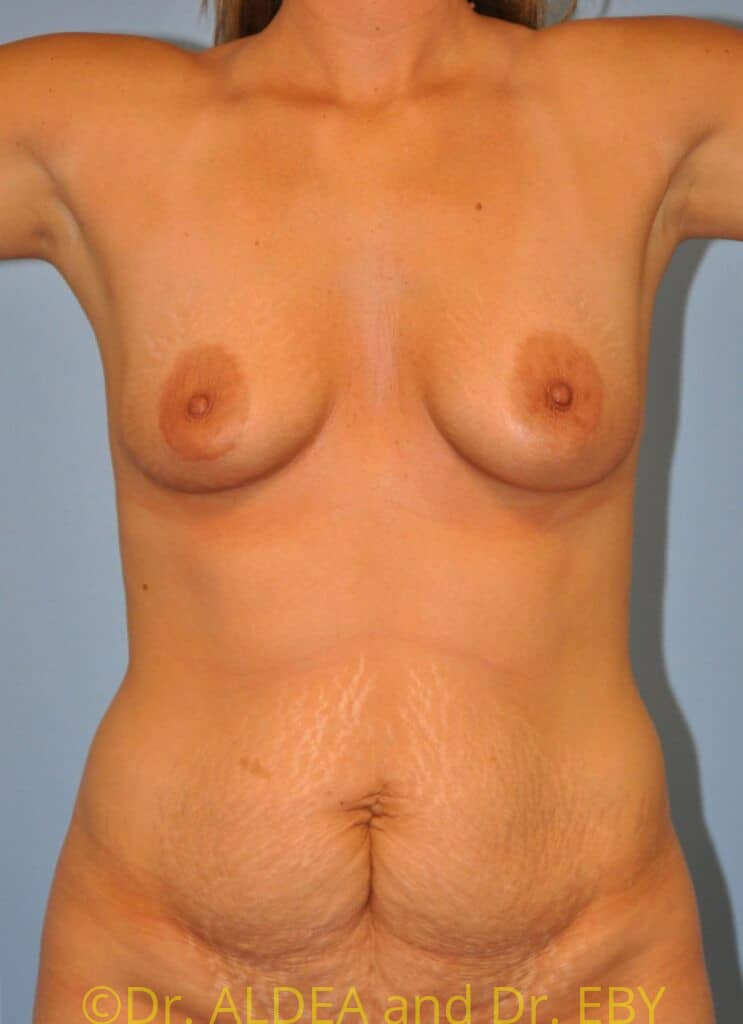 Before Image: Tummy Tuck #465 - front