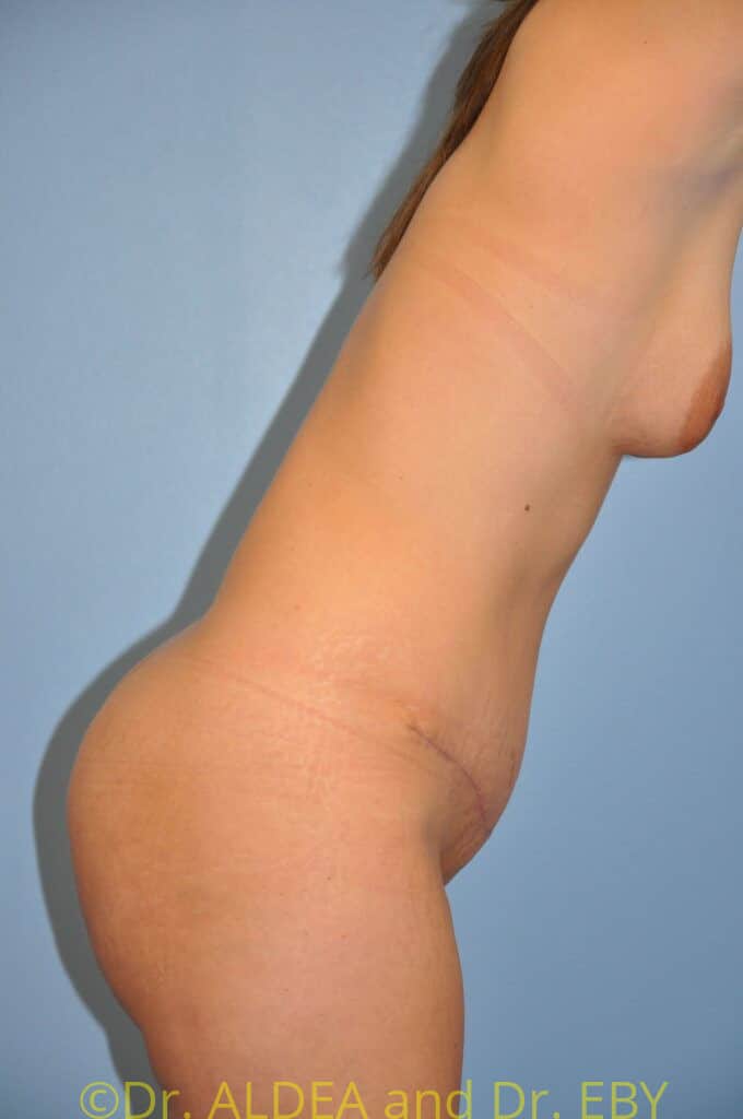 After Image: Tummy Tuck #465 - other