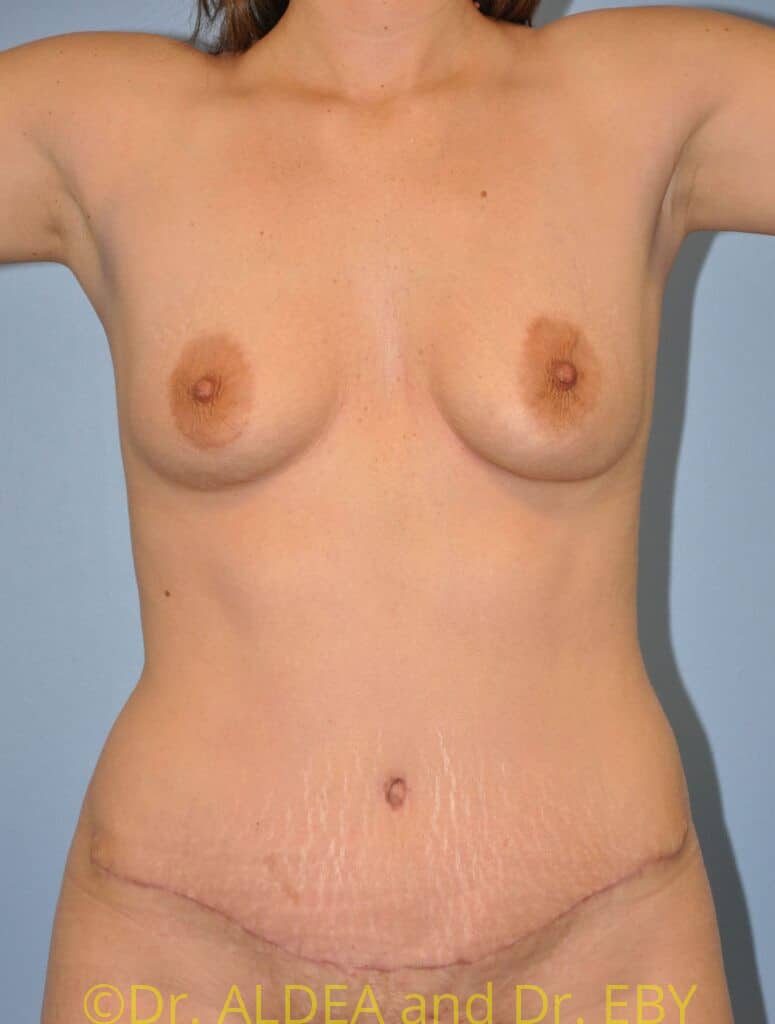 After Image: Tummy Tuck #465 - front