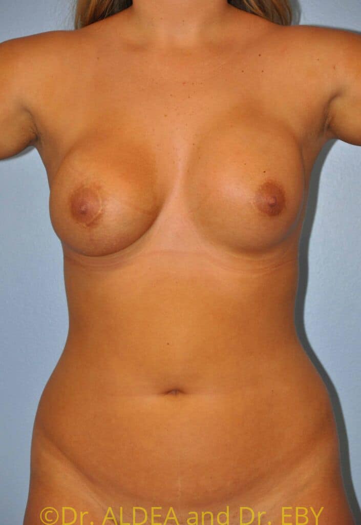 After Image: Breast Augmentation w/ Lift #907 - front