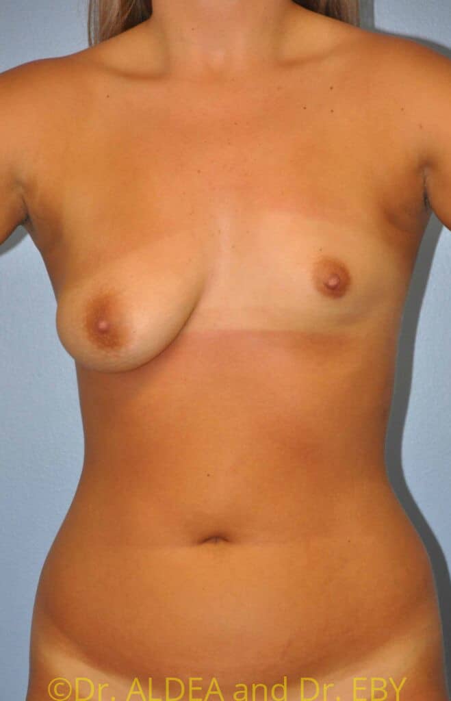 Before Image: Breast Augmentation w/ Lift #907 - front