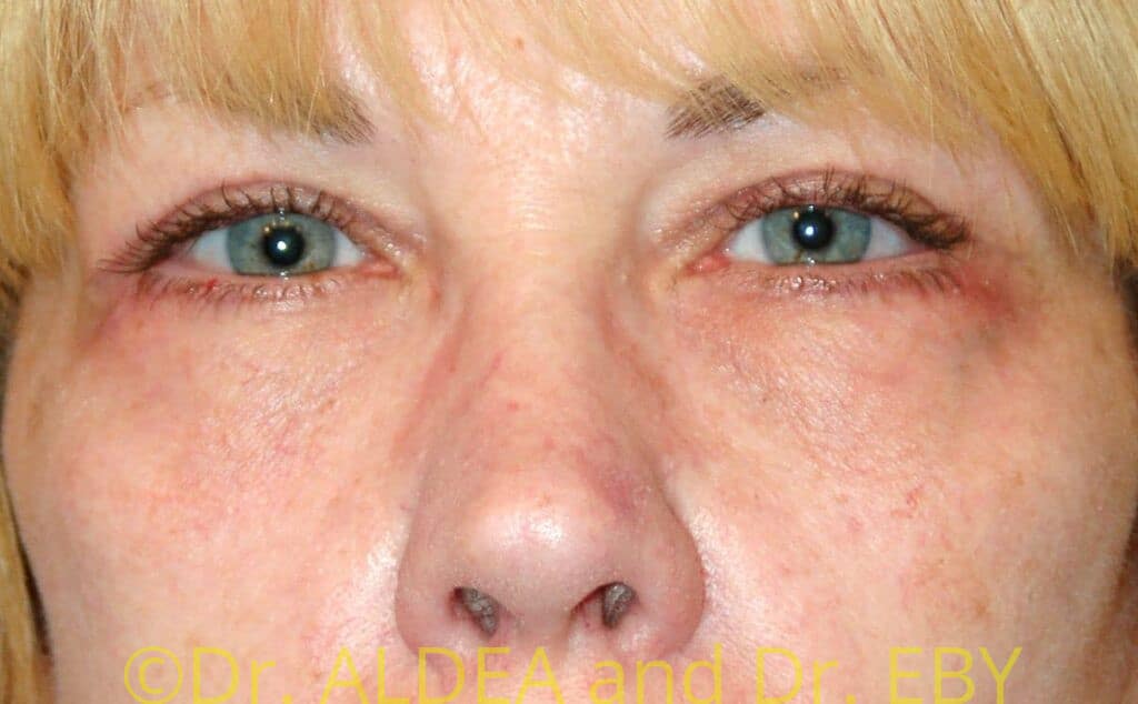 After Image: Blepharoplasty #484 - front