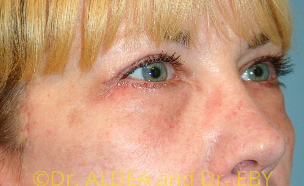 After Image: Blepharoplasty #484 - right-front-oblique