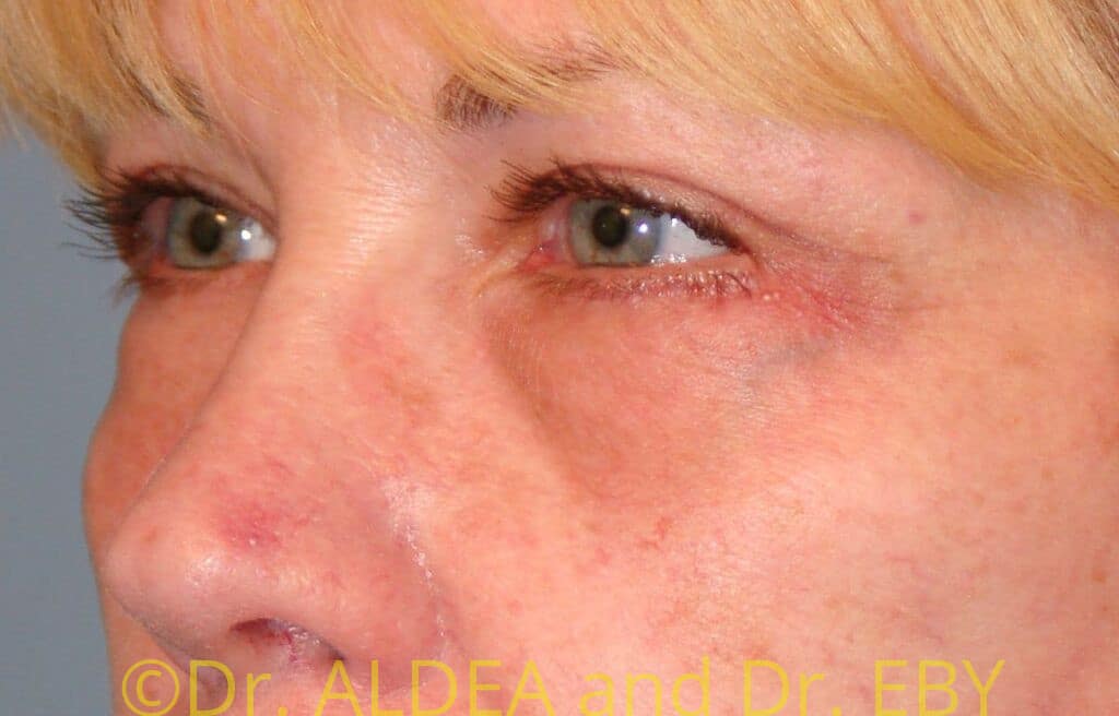 After Image: Blepharoplasty #484 - left-front-oblique