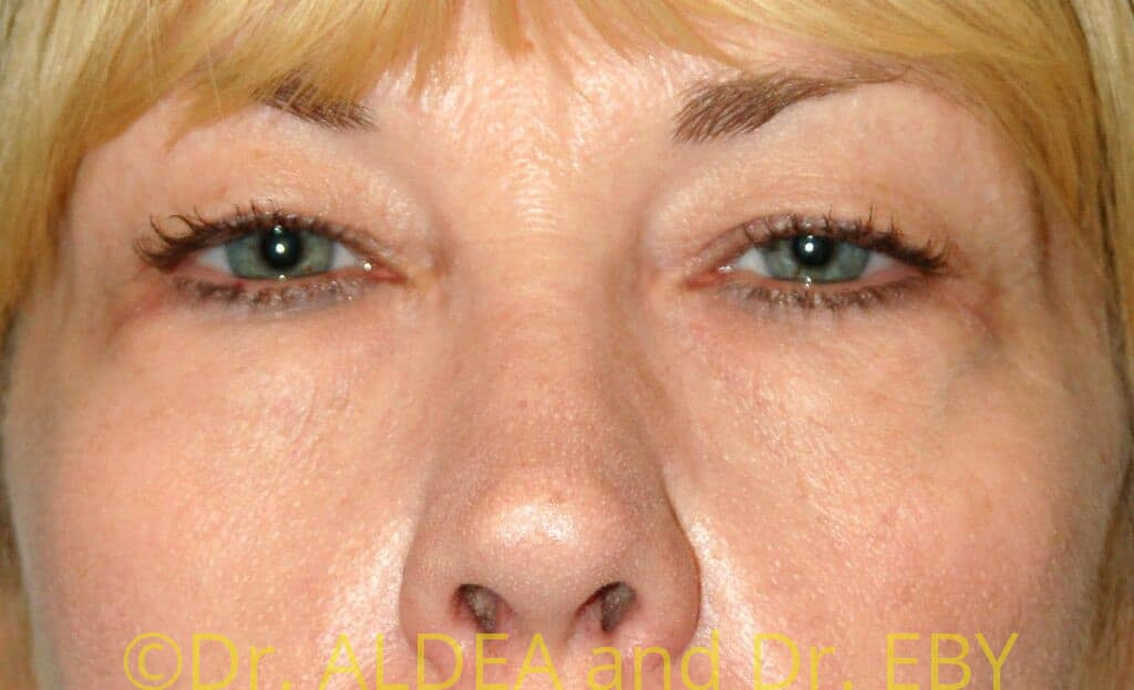 Before Image: Blepharoplasty #484 - front