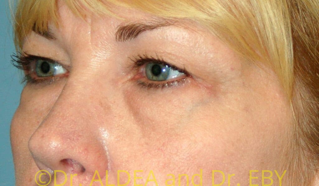 Before Image: Blepharoplasty #484 - left-front-oblique