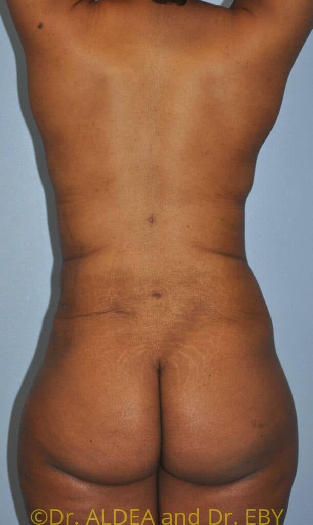 After Image: Back Scoop Liposuction #802 - back