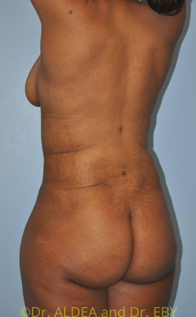 After Image: Back Scoop Liposuction #802 - left-back-oblique