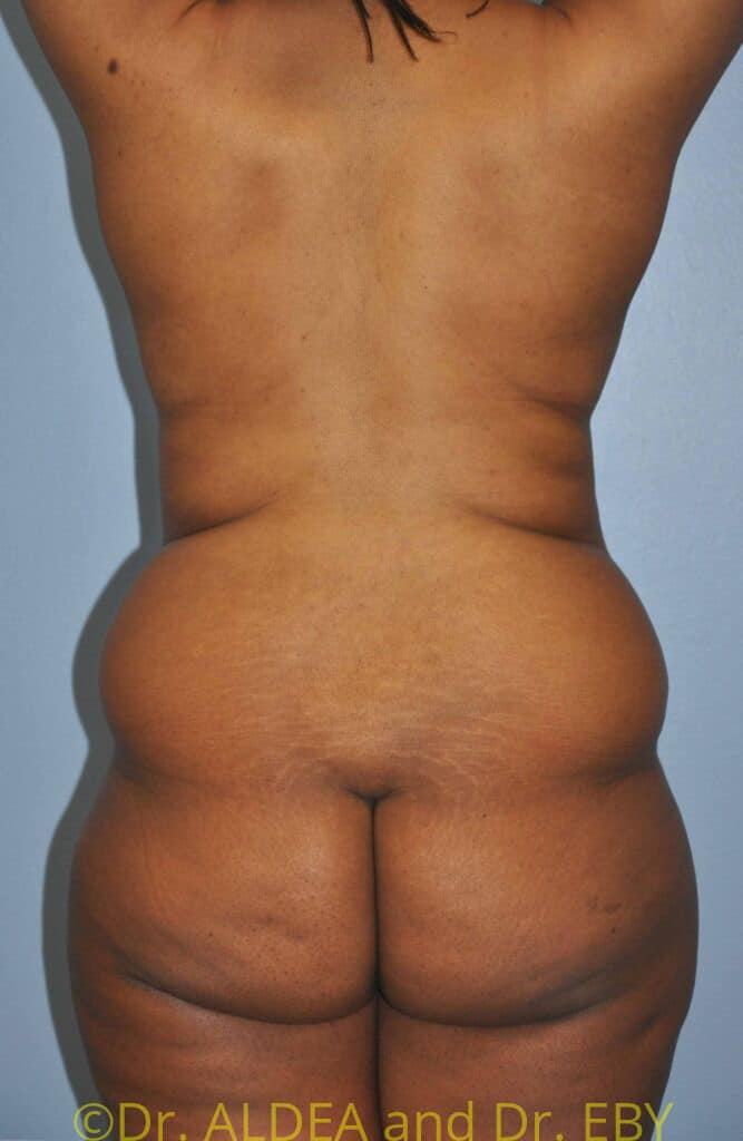 Before Image: Back Scoop Liposuction #802 - back