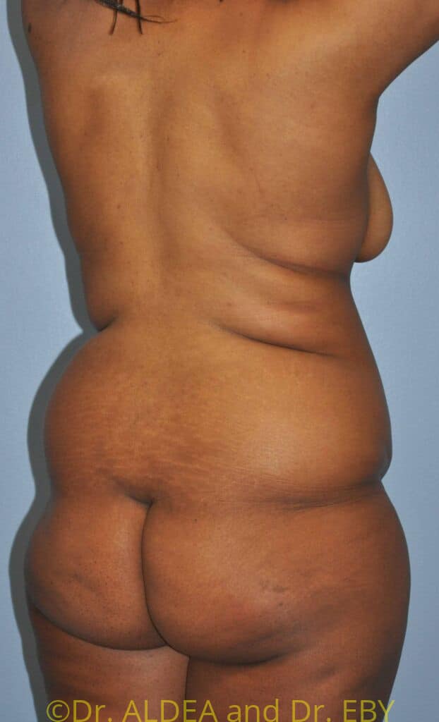 Before Image: Back Scoop Liposuction #802 - right-back-oblique