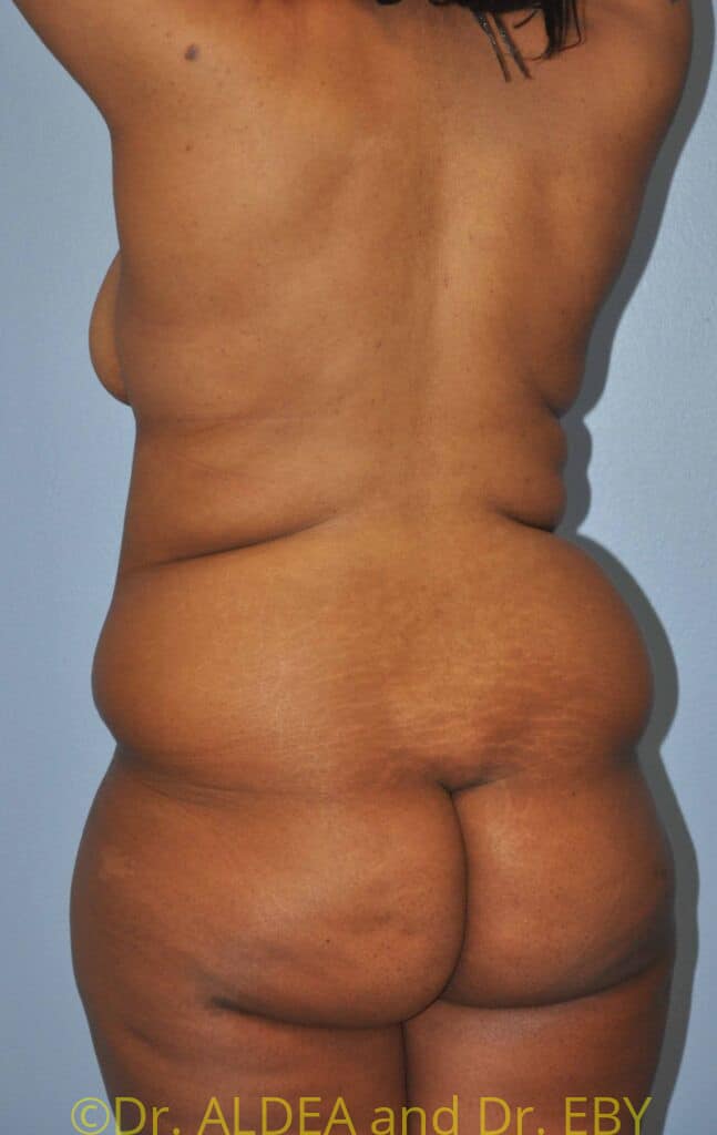 Before Image: Back Scoop Liposuction #802 - left-back-oblique