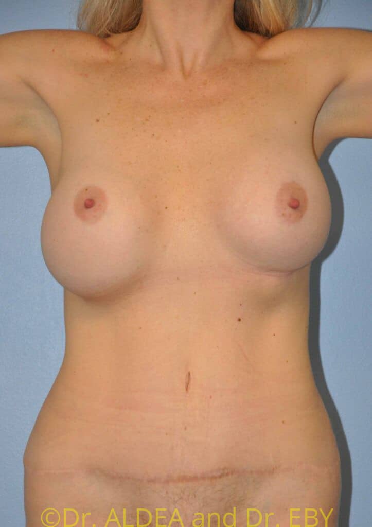 Before Image: Breast Implant Exchange with Lift #812 - front