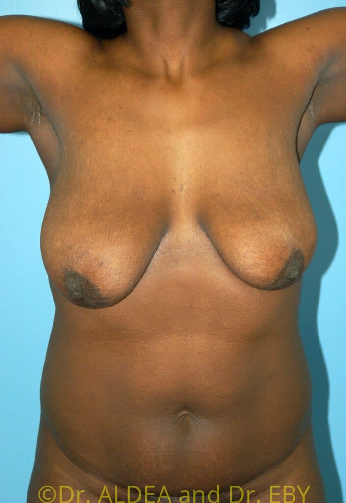 Before Image: Short Scar Breast Lift (Mastopexy) #496 - front