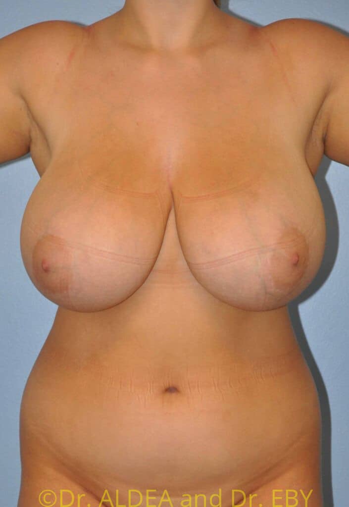 Before Image: Short Scar Breast Reduction #298 - front