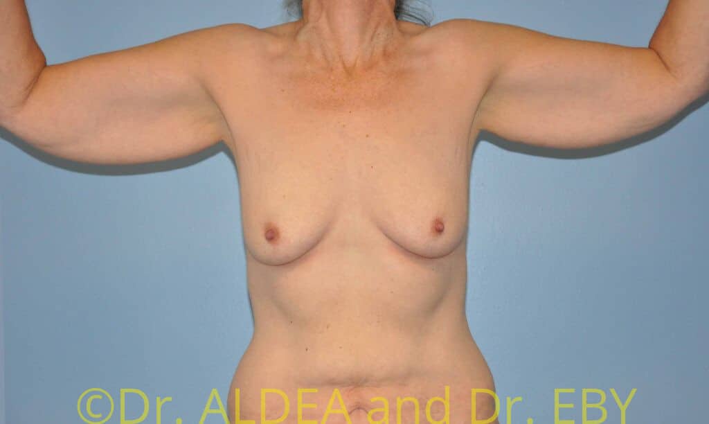 Before Image: Brachioplasty #948 - front