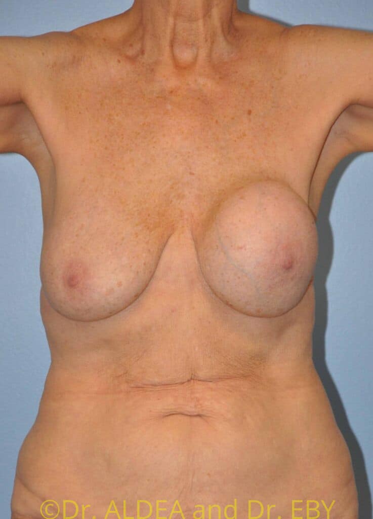 Before Image: Breast Implant Removal (Explantation) WITH a Lift #755 - front