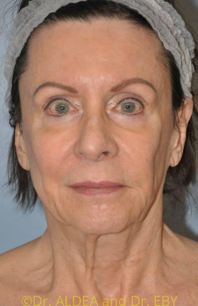 Before Image: Facelift #851 - front