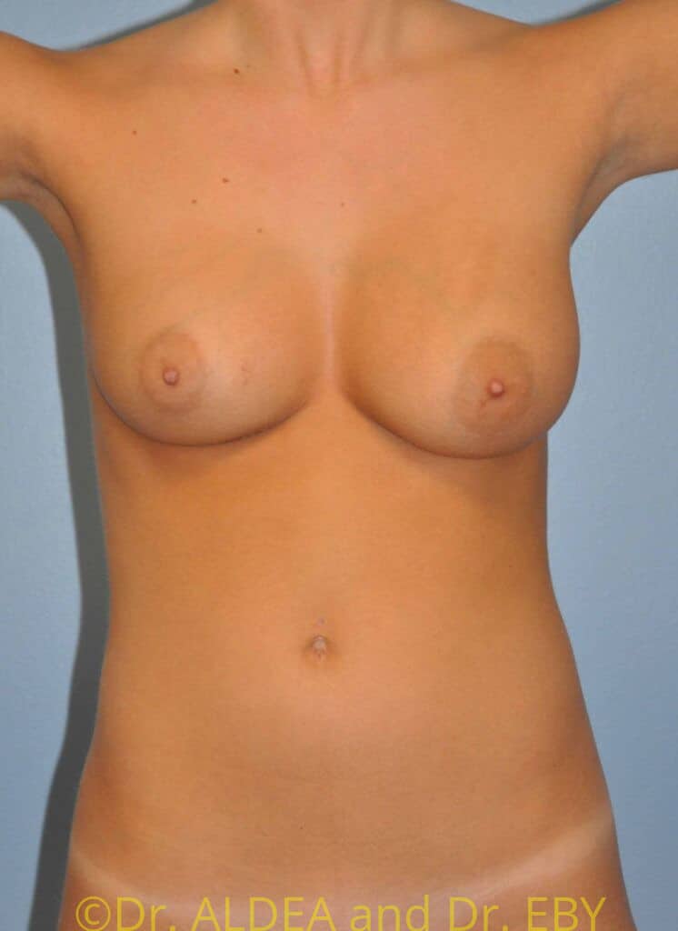 Before Image: Fat Transfer to Breasts #289 - front