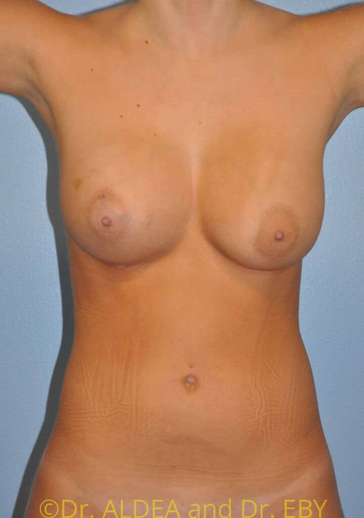 After Image: Fat Transfer to Breasts #289 - front