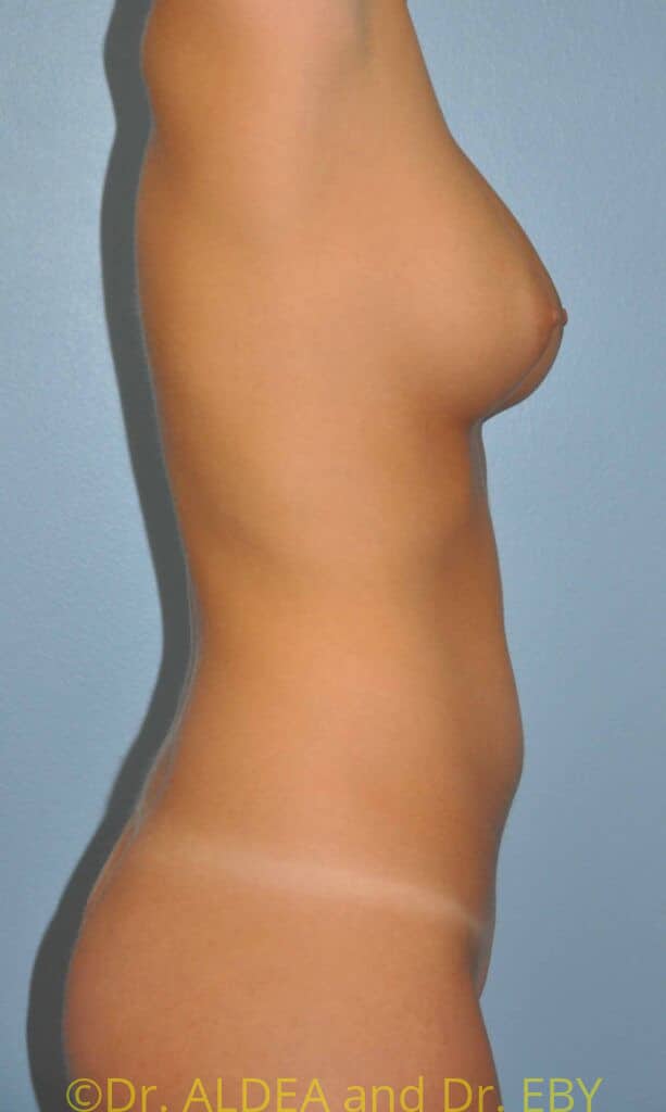 Before Image: Fat Transfer to Breasts #289 - right-side