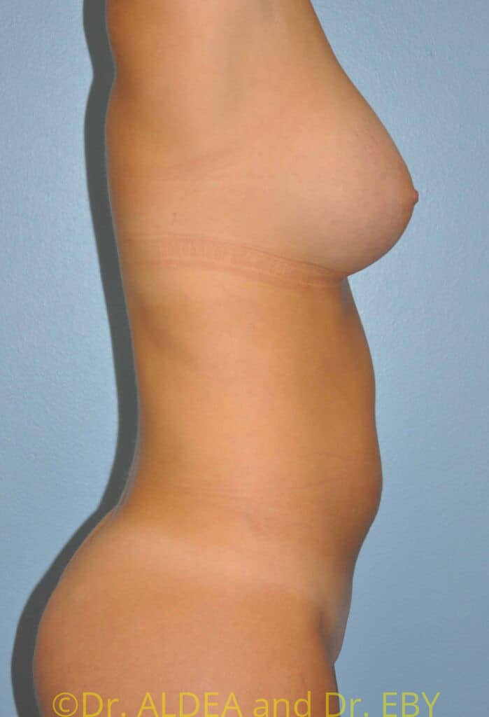 After Image: Fat Transfer to Breasts #289 - right-side