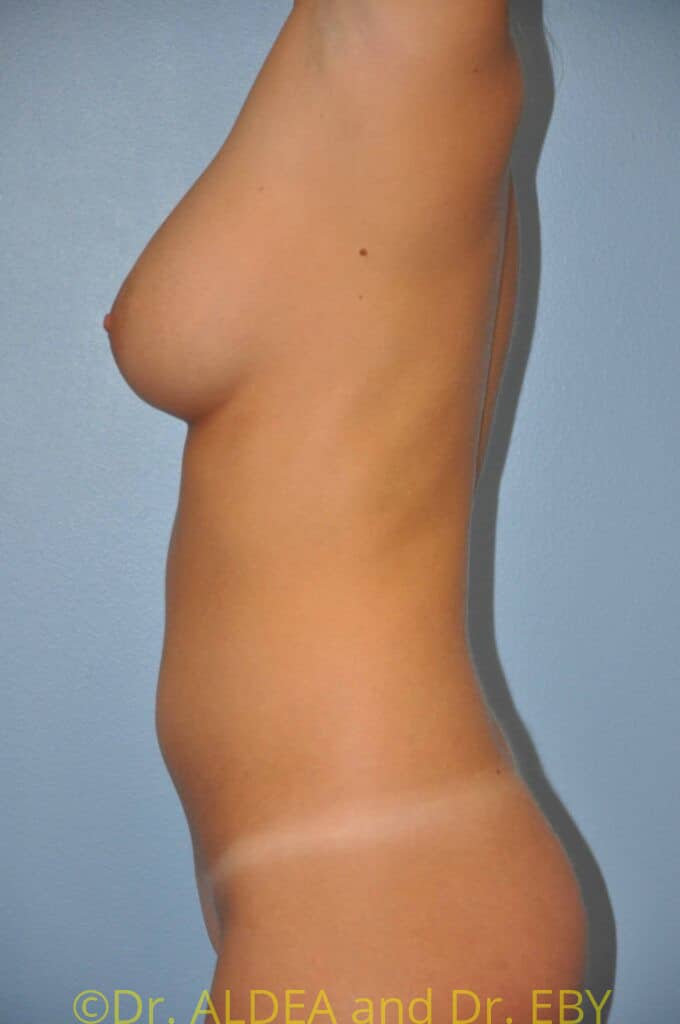 Before Image: Fat Transfer to Breasts #289 - left-side