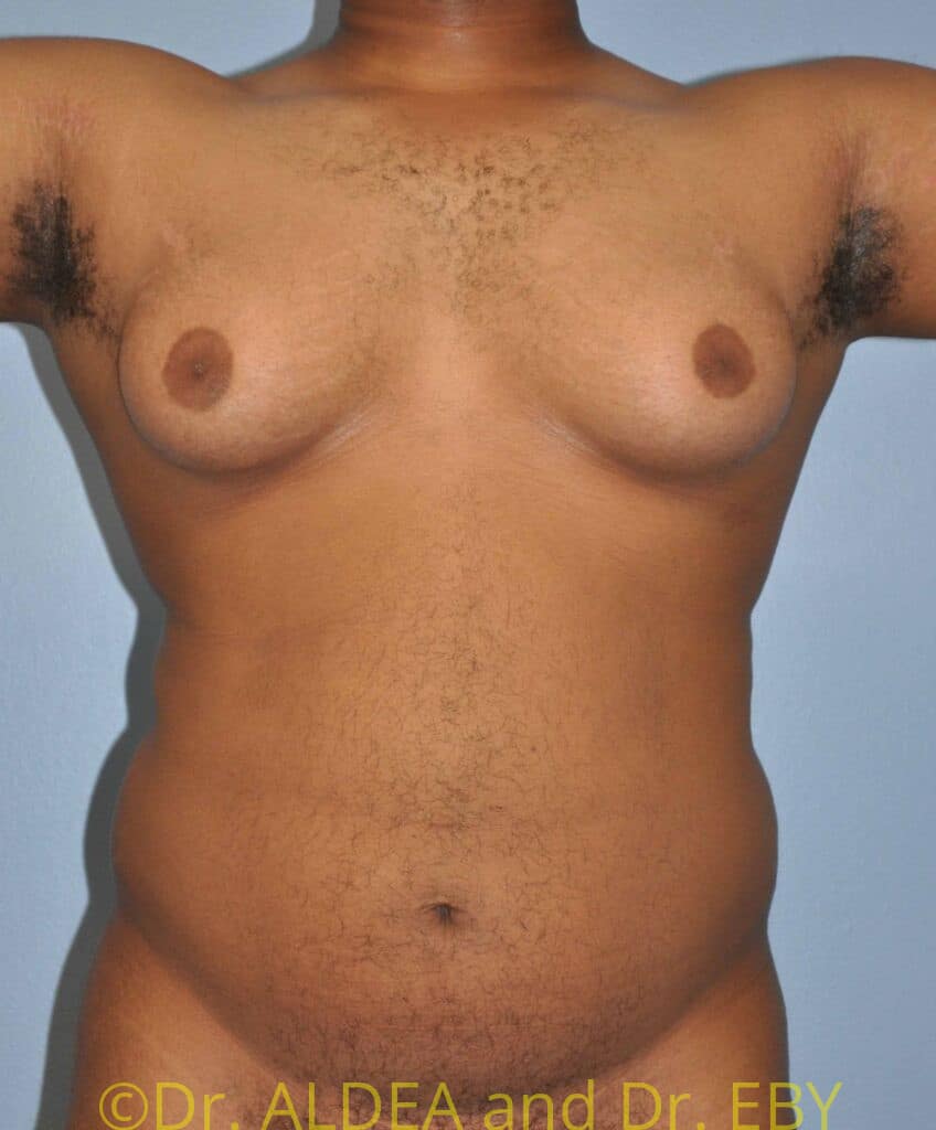 Before Image: Gynecomastia #209 - front