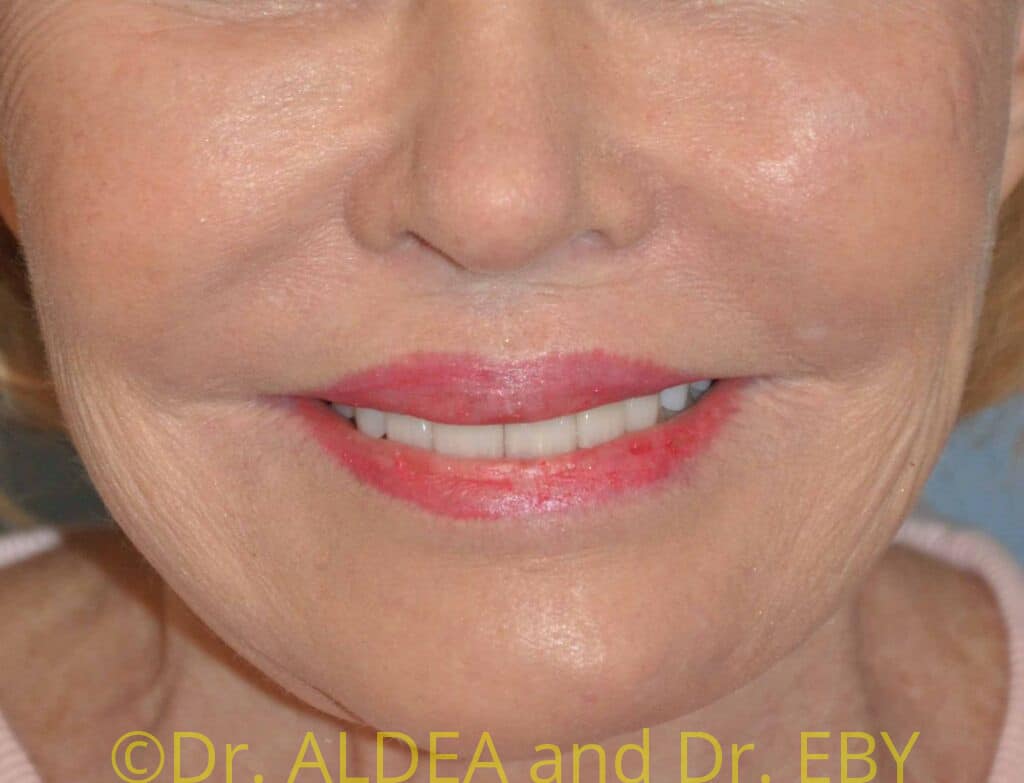 Before Image: Lip Lift #853 - front