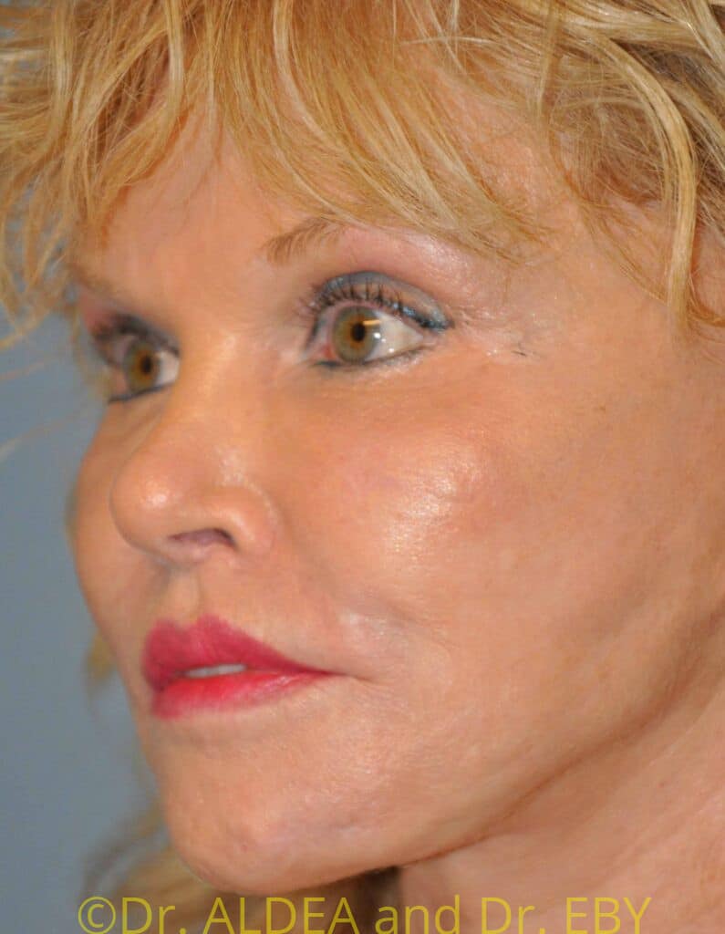 After Image: Lip Lift #853 - left-front-oblique
