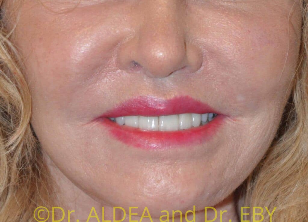 After Image: Lip Lift #853 - front