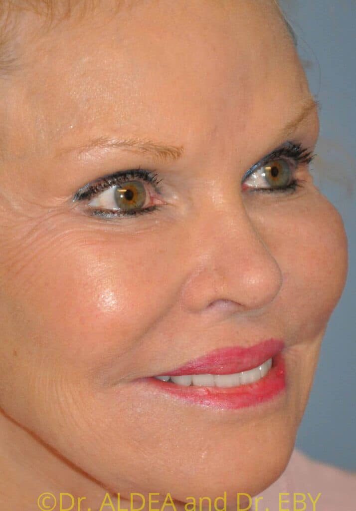 Before Image: Lip Lift #853 - right-front-oblique