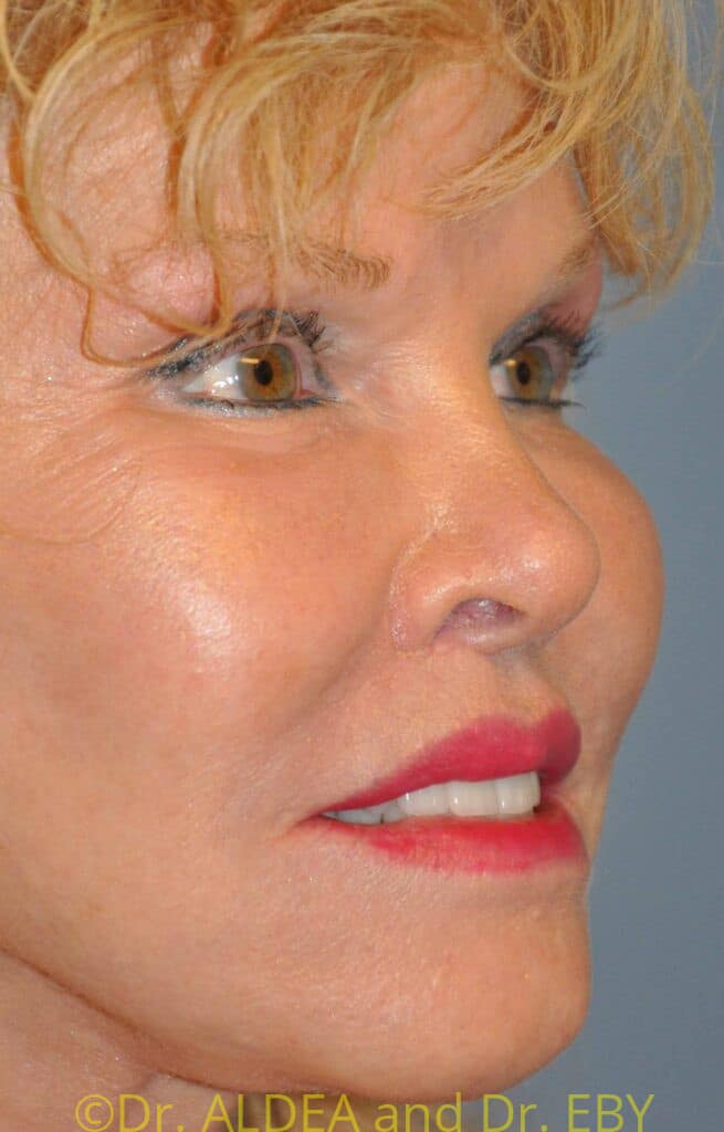 After Image: Lip Lift #853 - right-front-oblique