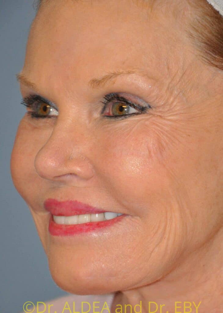 Before Image: Lip Lift #853 - left-front-oblique