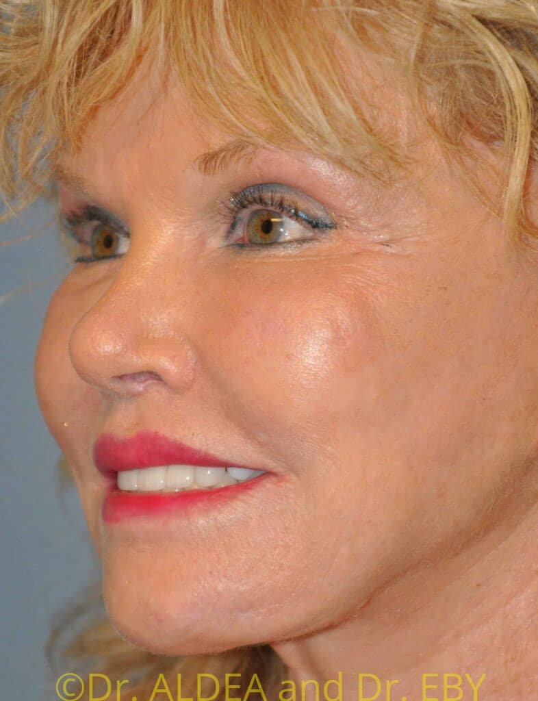 After Image: Lip Lift #853 - left-front-oblique