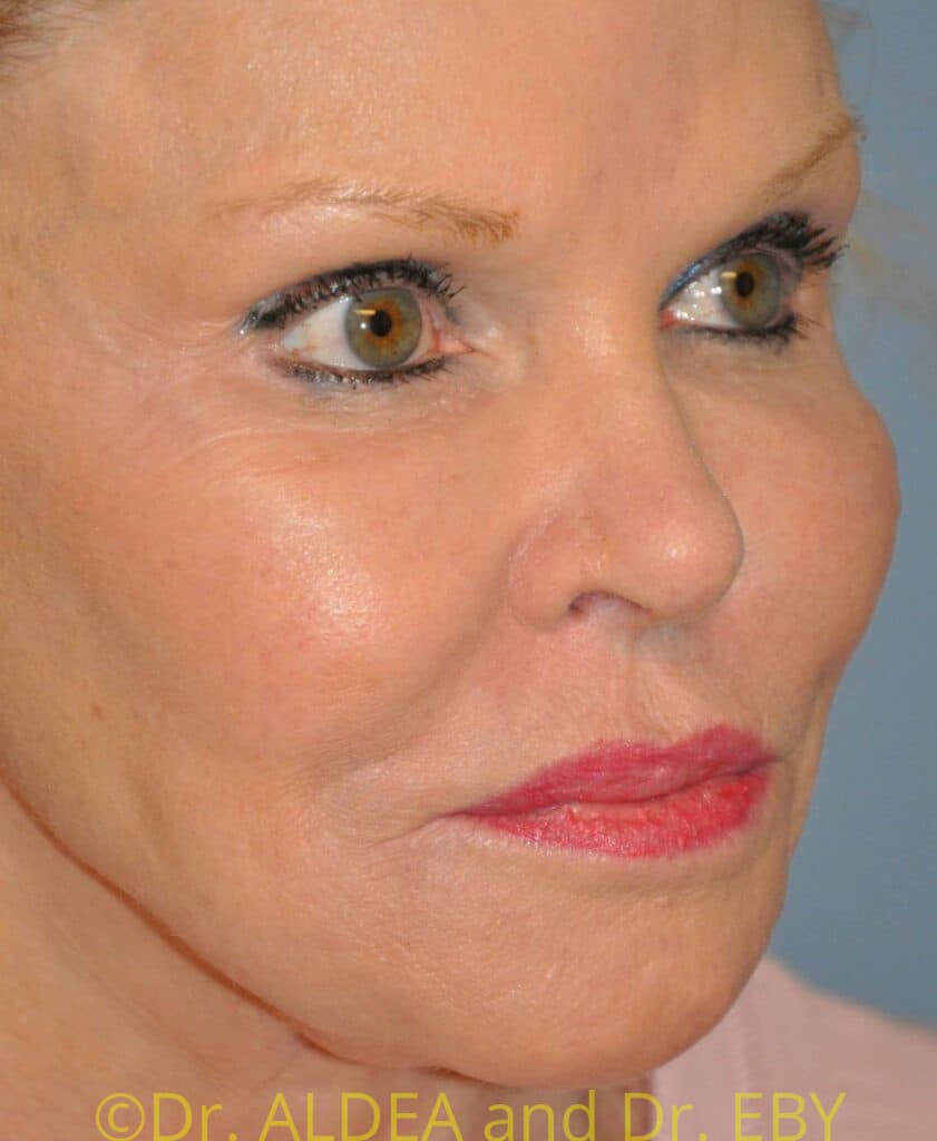 Before Image: Lip Lift #853 - right-front-oblique