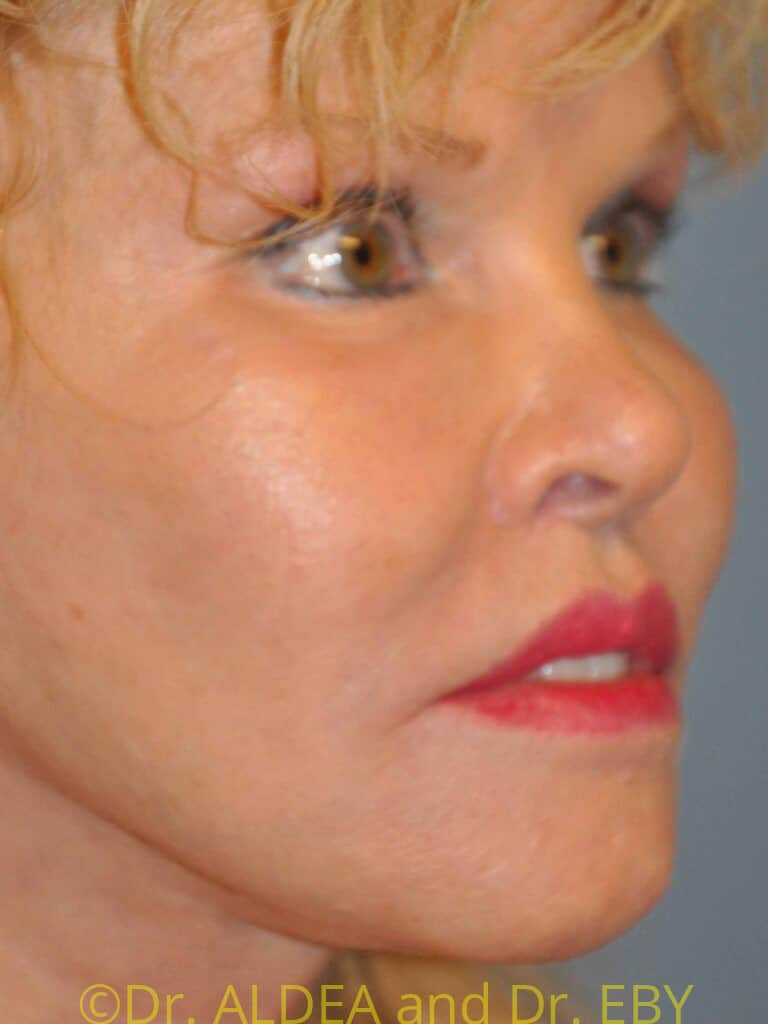 After Image: Lip Lift #853 - right-front-oblique