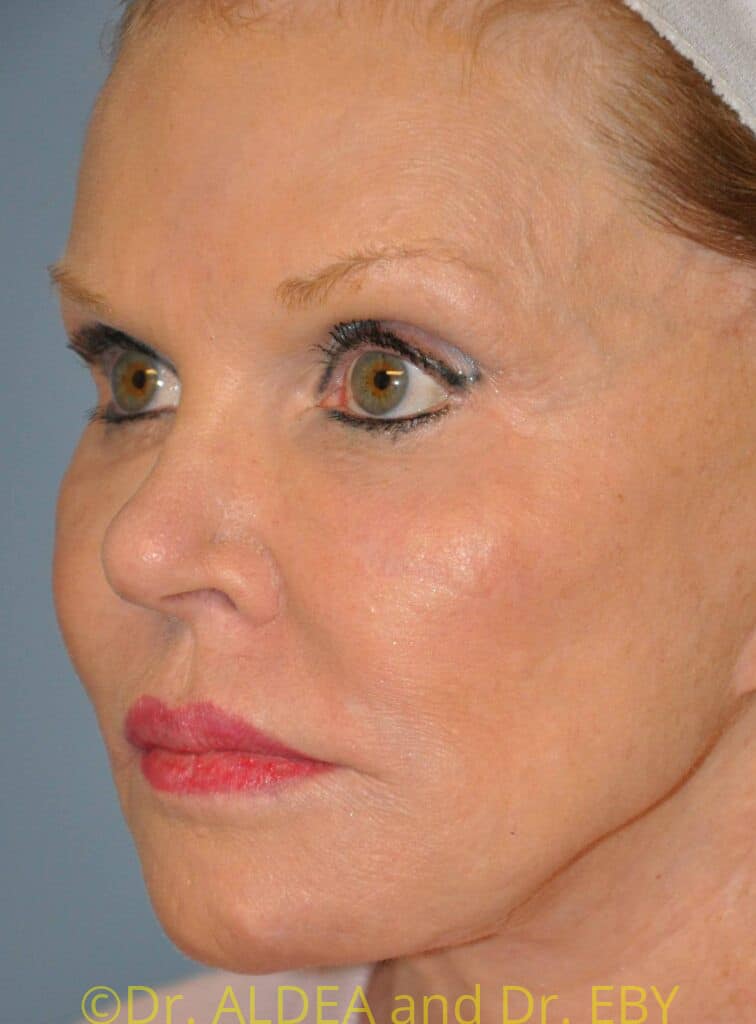 Before Image: Lip Lift #853 - left-front-oblique