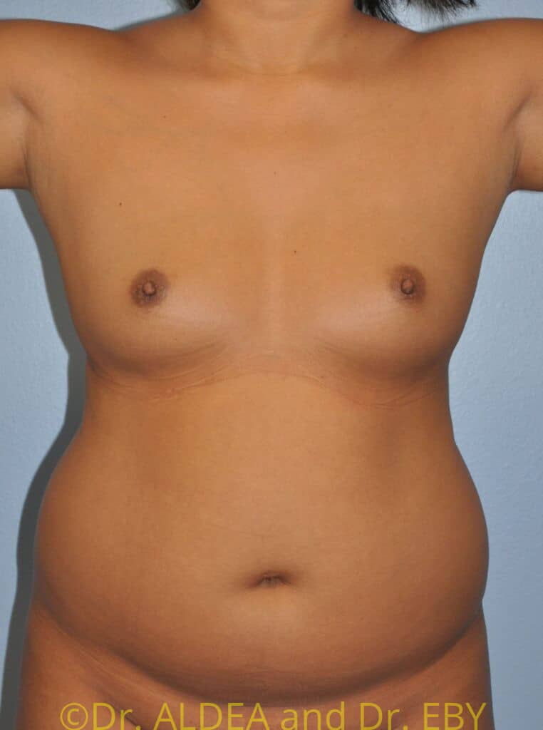 Before Image: Liposuction #670 - front