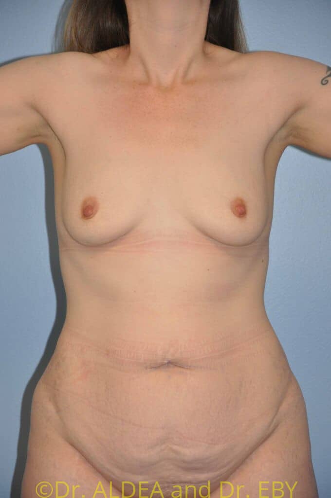 Before Image: Mommy Makeover #102 - front