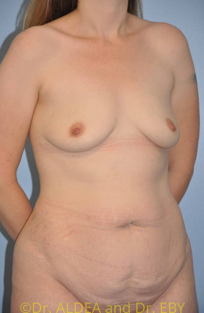 Before Image: Mommy Makeover #102 - right-front-oblique
