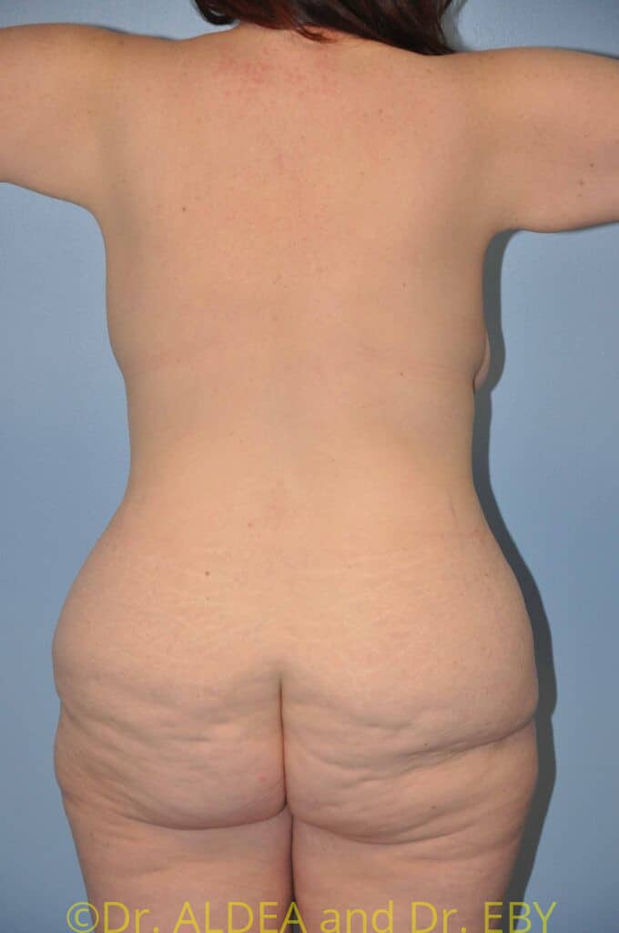 Before Image: Weight loss (MWL) Butt and Thigh Lift #171 - back