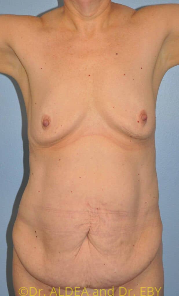 Before Image: Massive Weight Loss Tummy Tuck #109 - front