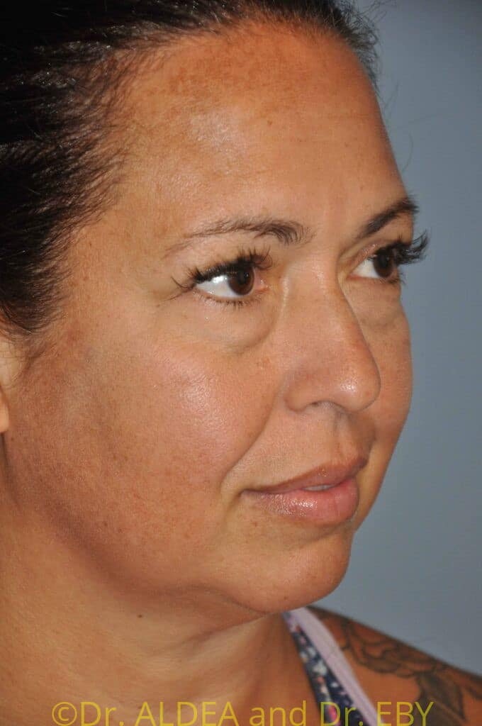 Before Image: Neck Liposuction #356 - right-front-oblique