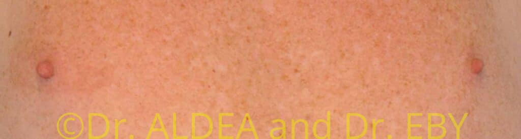 Before Image: Nipple Reduction #063 - front