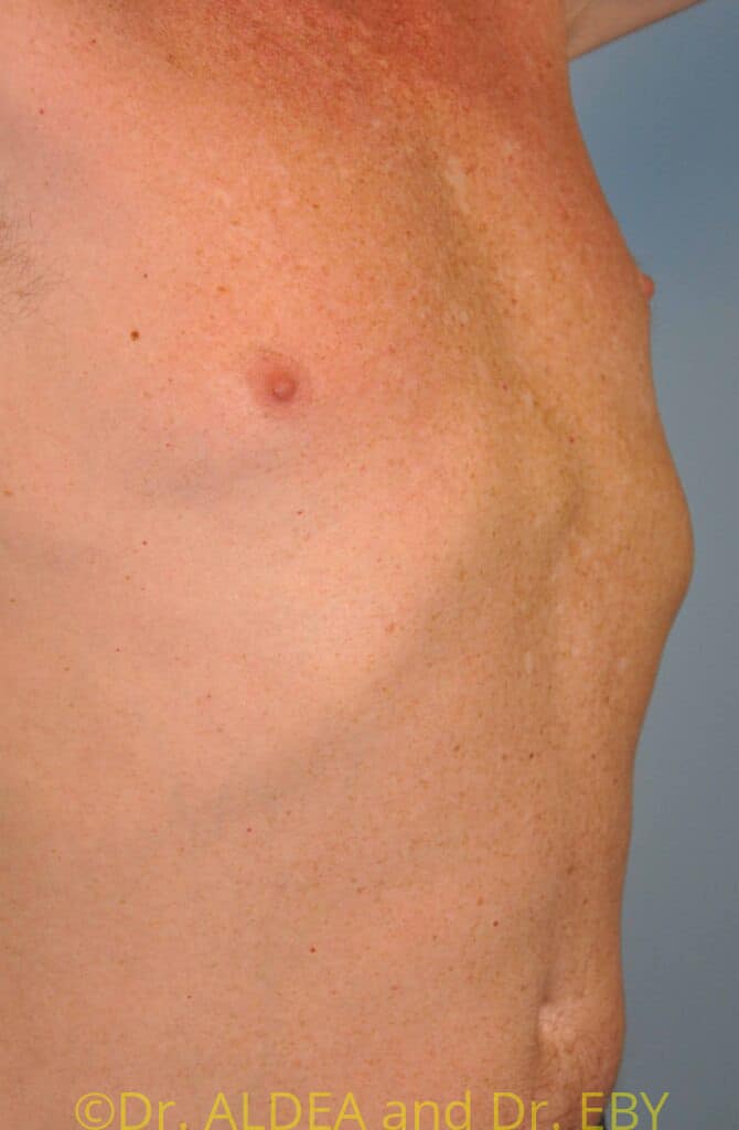 After Image: Nipple Reduction #063 - right-front-oblique