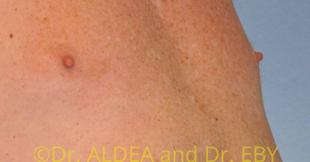 Before Image: Nipple Reduction #063 - right-front-oblique