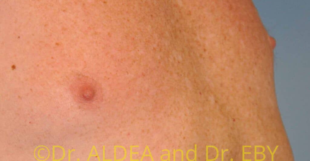After Image: Nipple Reduction #063 - right-front-oblique
