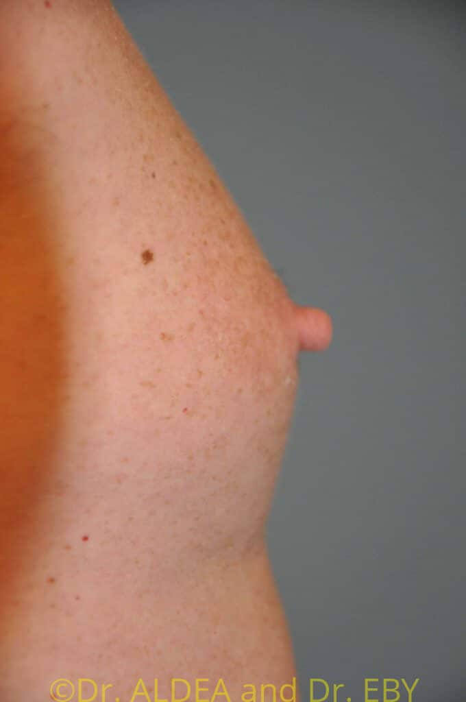 Before Image: Nipple Reduction #063 - right-side